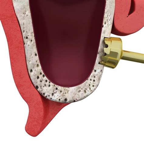 sinus lift port salerno fl|Sinus Lifts Explained: Procedure, Benefits & Recovery Tips.